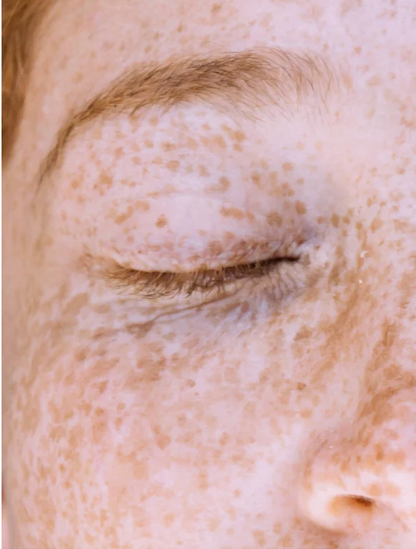 Close-up of a face with freckles illustrating uneven skin tone, related to kojic acid dark spot treatment.