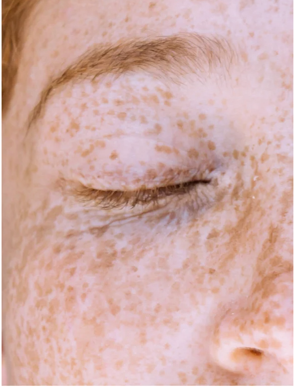 Close-up of a face with freckles representing skin pigmentation, highlighting the need for Dark Spot Face Cream with Kojic Acid.